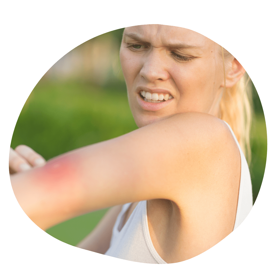 crema-para-picaduras