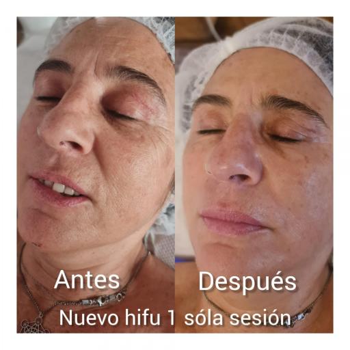 PACK ÚLTIMO HIFU FACIAL COMPLETO + CUELLO 2 SESIONES [0]