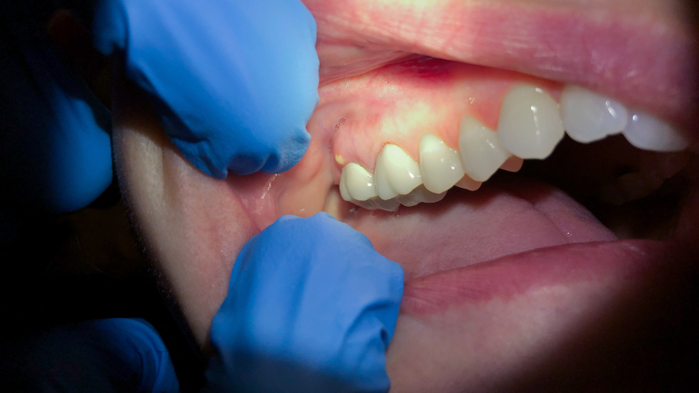 Flemón o Absceso dental: síntomas, causas y tratamiento