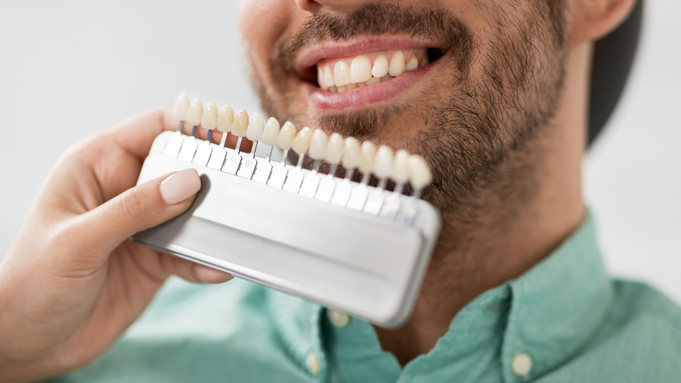 Carillas dentales: Todo lo que debes saber