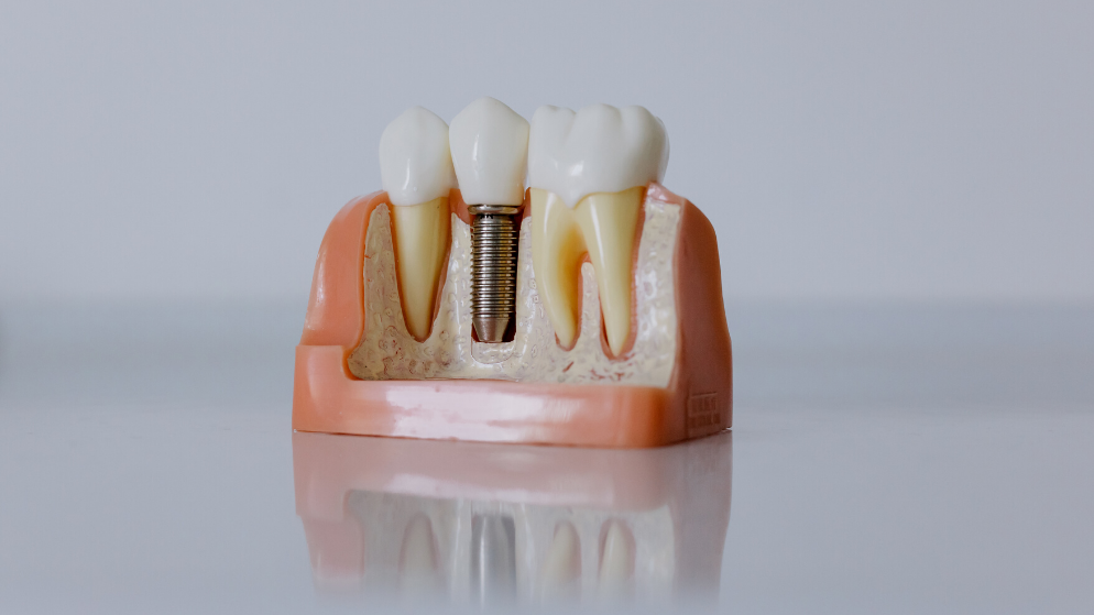 7 formas de cuidar tus implantes dentales