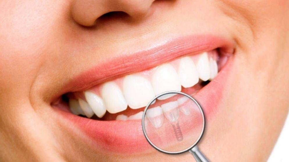 Implantes dentales de carga inmediata o “dientes en un día”