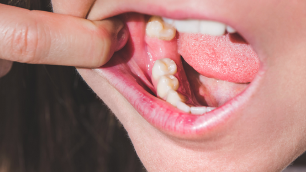 ¿Cómo evitar la retracción de encías y la pérdida de hueso después de una extracción dental?