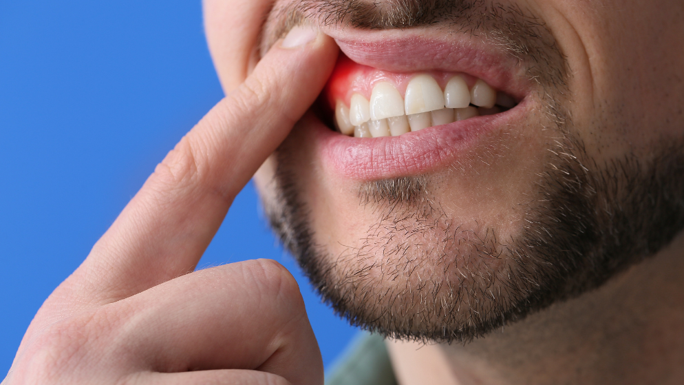 ¿Qué es la gingivitis? Síntomas, causas y tratamientos