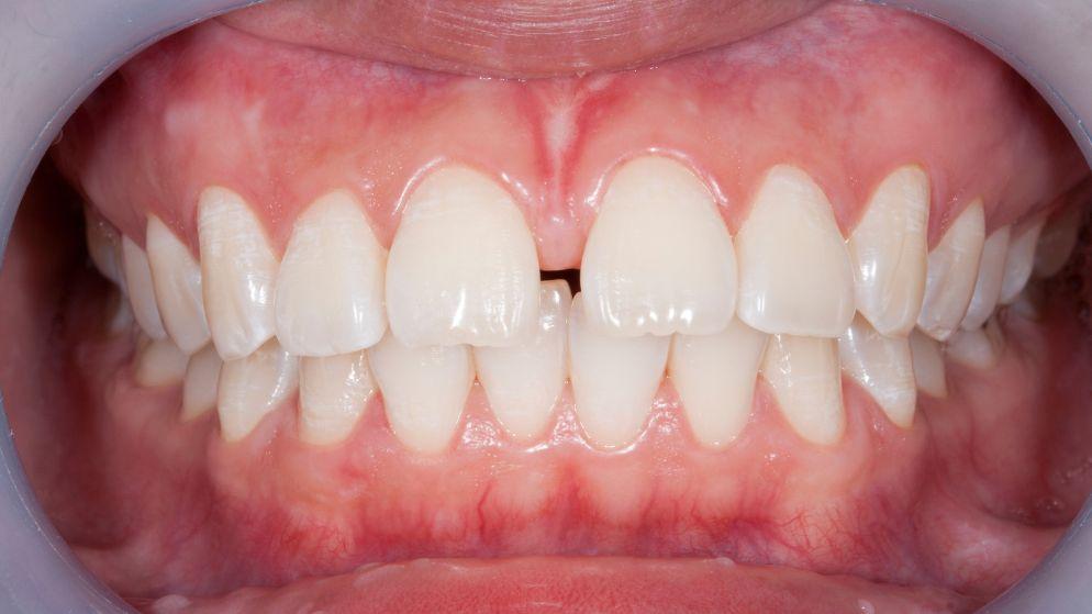 Troneras dentales ¿qué son y por qué aparecen?