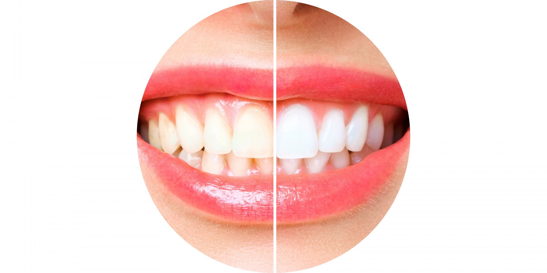 blanqueamiento dental antes y despues