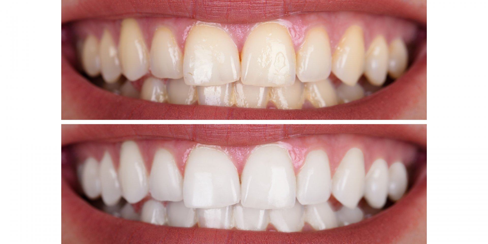 ventajas del blanqueamiento dental