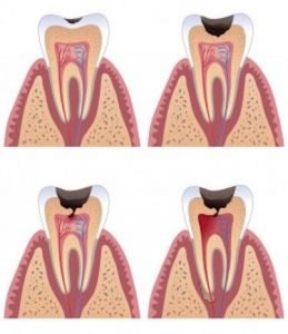 fases caries diente