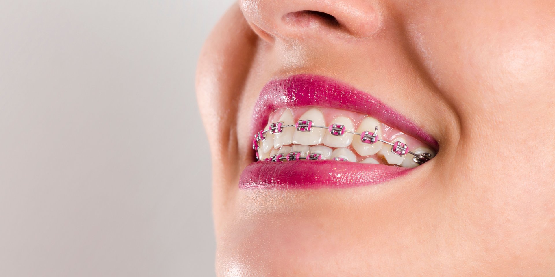 ejemplo brackets metálicos