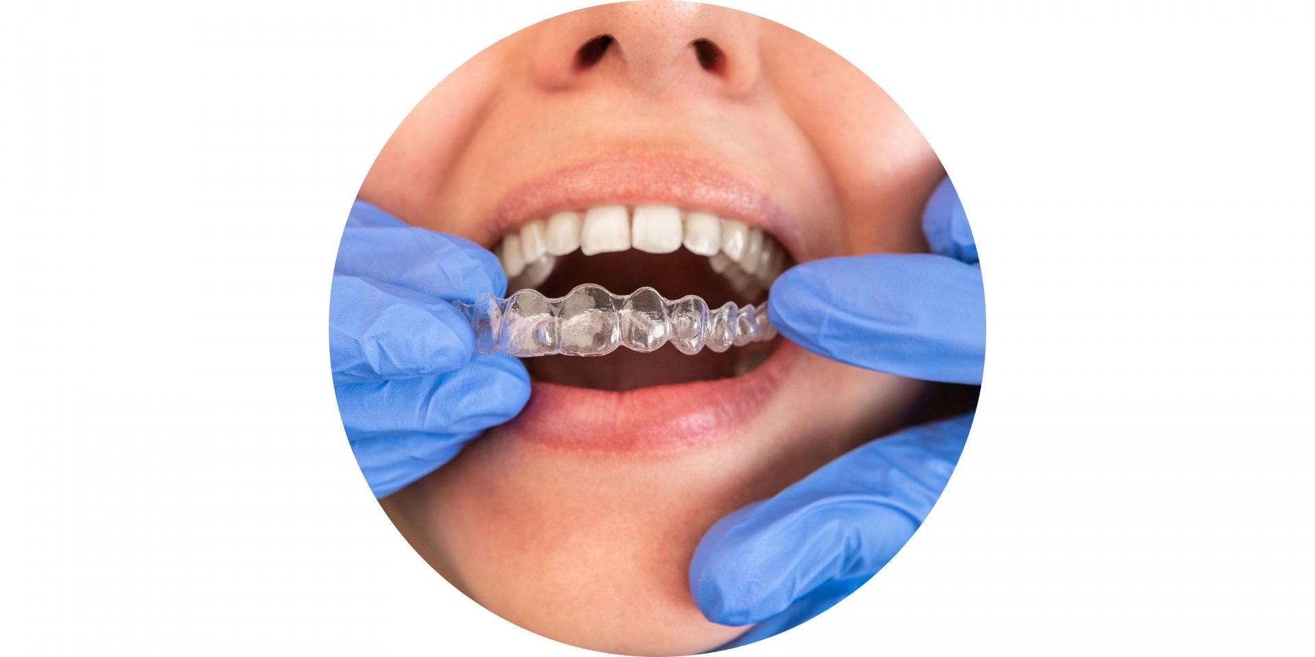 experiencia con alineadores invisibles