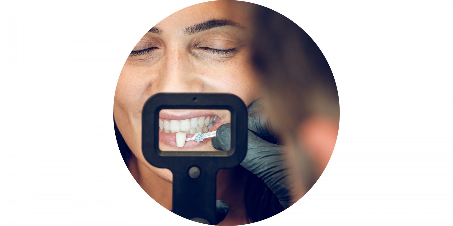 experiencia en carillas dentales