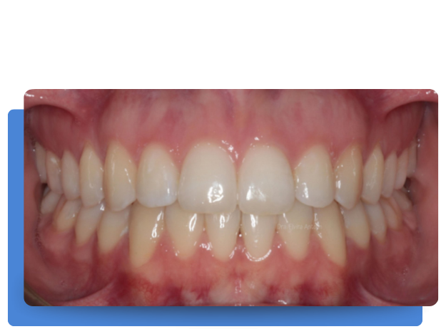 despues de ortodoncia con Clinica Tello