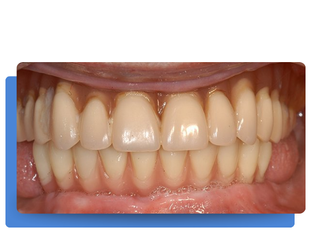 despues de implante con Clinica Tello