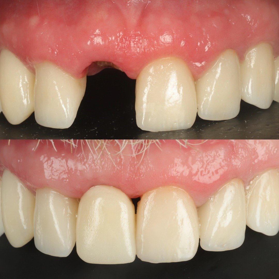 IMPLANTE ANTERIOR ESTÉTICO.jpg