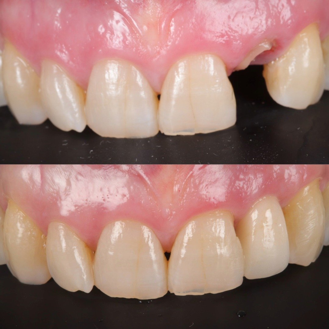 IMPLANTE POSTEXTRACIÓN.jpg