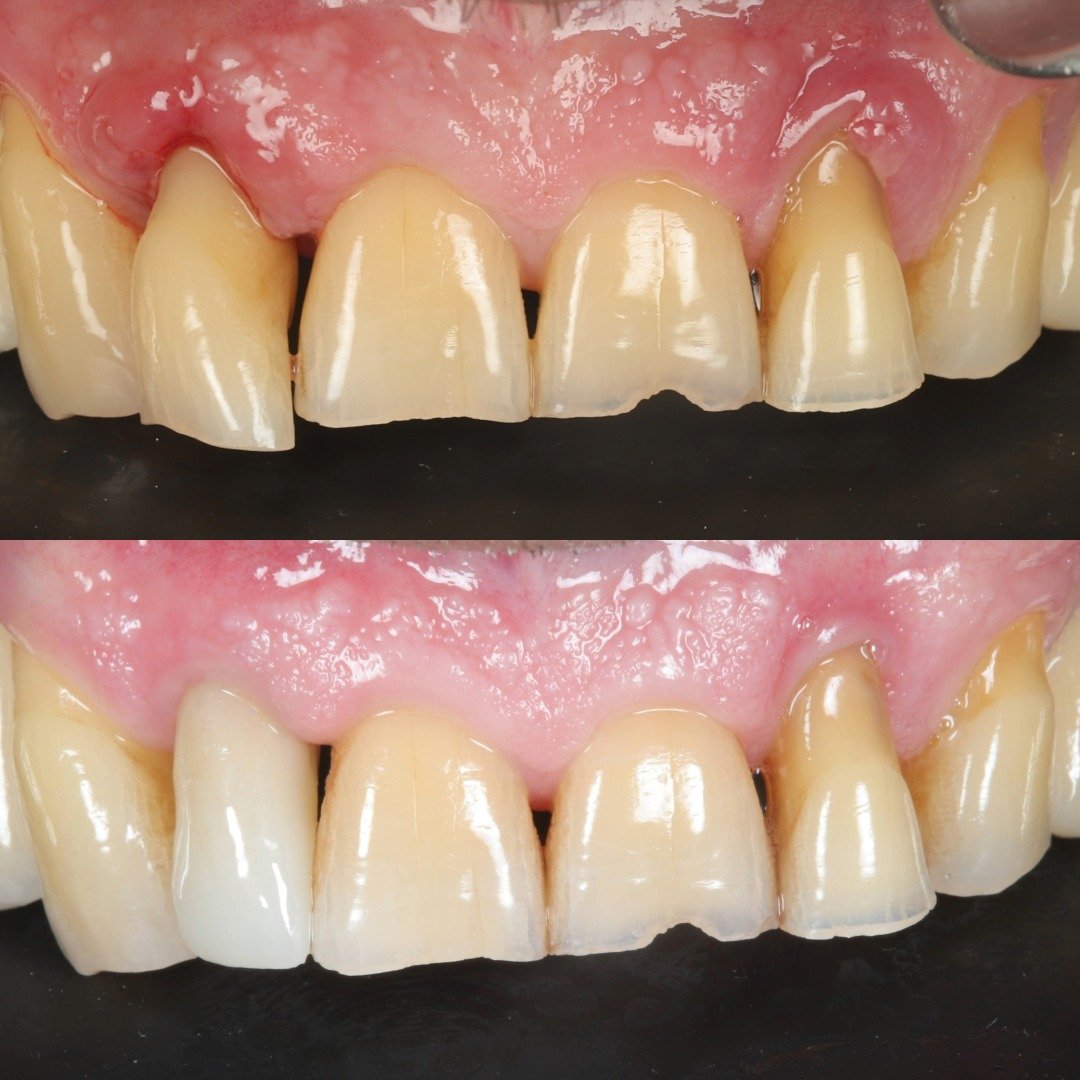 IMPLANTE Y REGENARIÓN MUCOSA.jpg