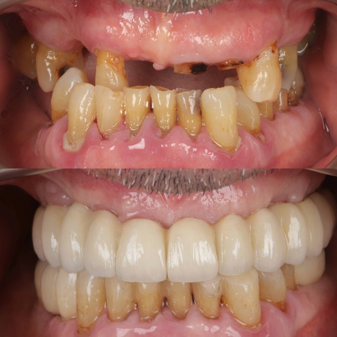 IMPLANTES MULTIPLES.jpg