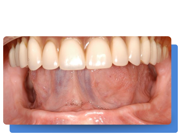 antes de implante con Clinica Tello