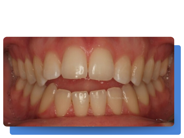 antes de ortodoncia con Clinica Tello