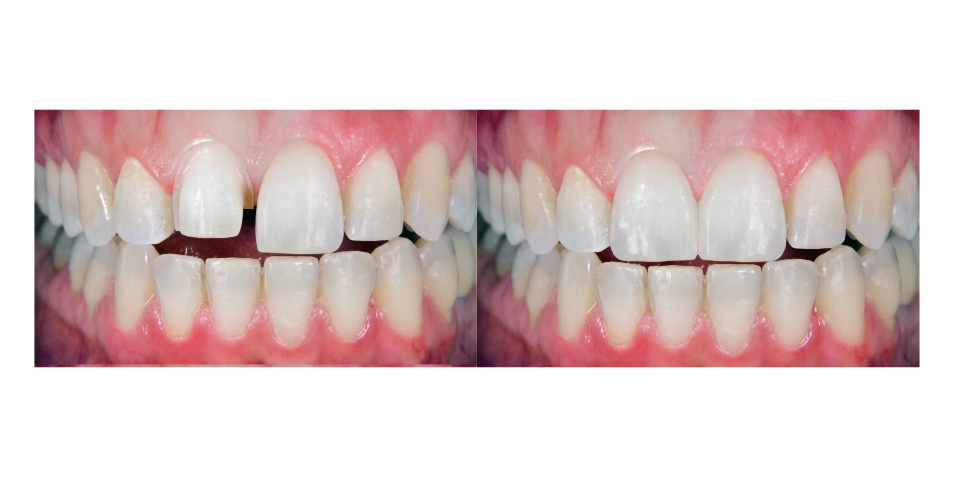 resultados tratamiento carillas
