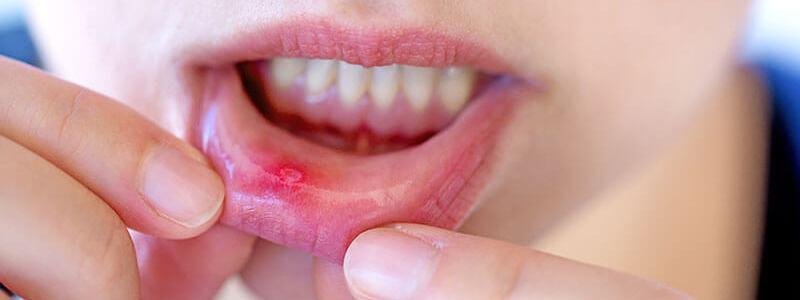 Aftas  y alteraciones bucales